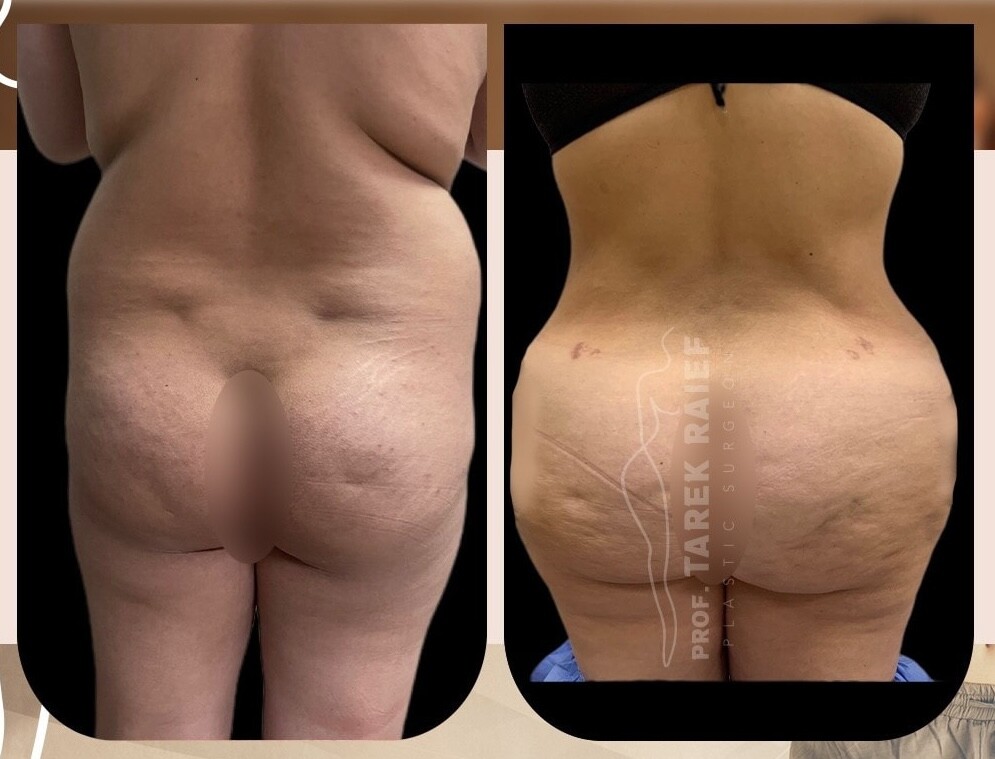 Before and After Result